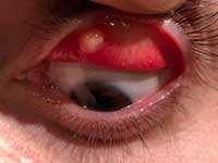 chalazion internal