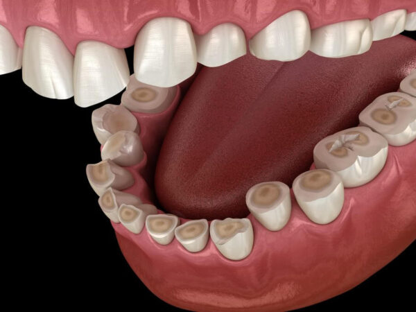 dental erosion