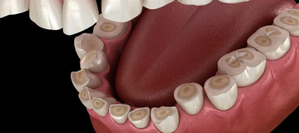 dental erosion