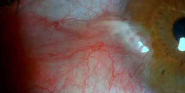 pterygium surgery