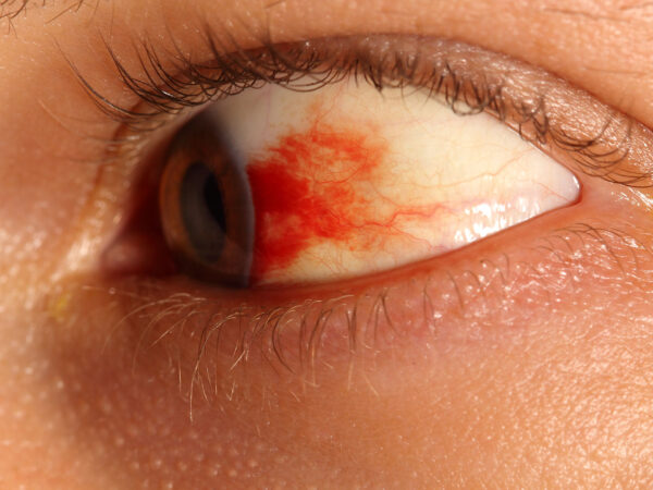 subconjunctival hemorrhage